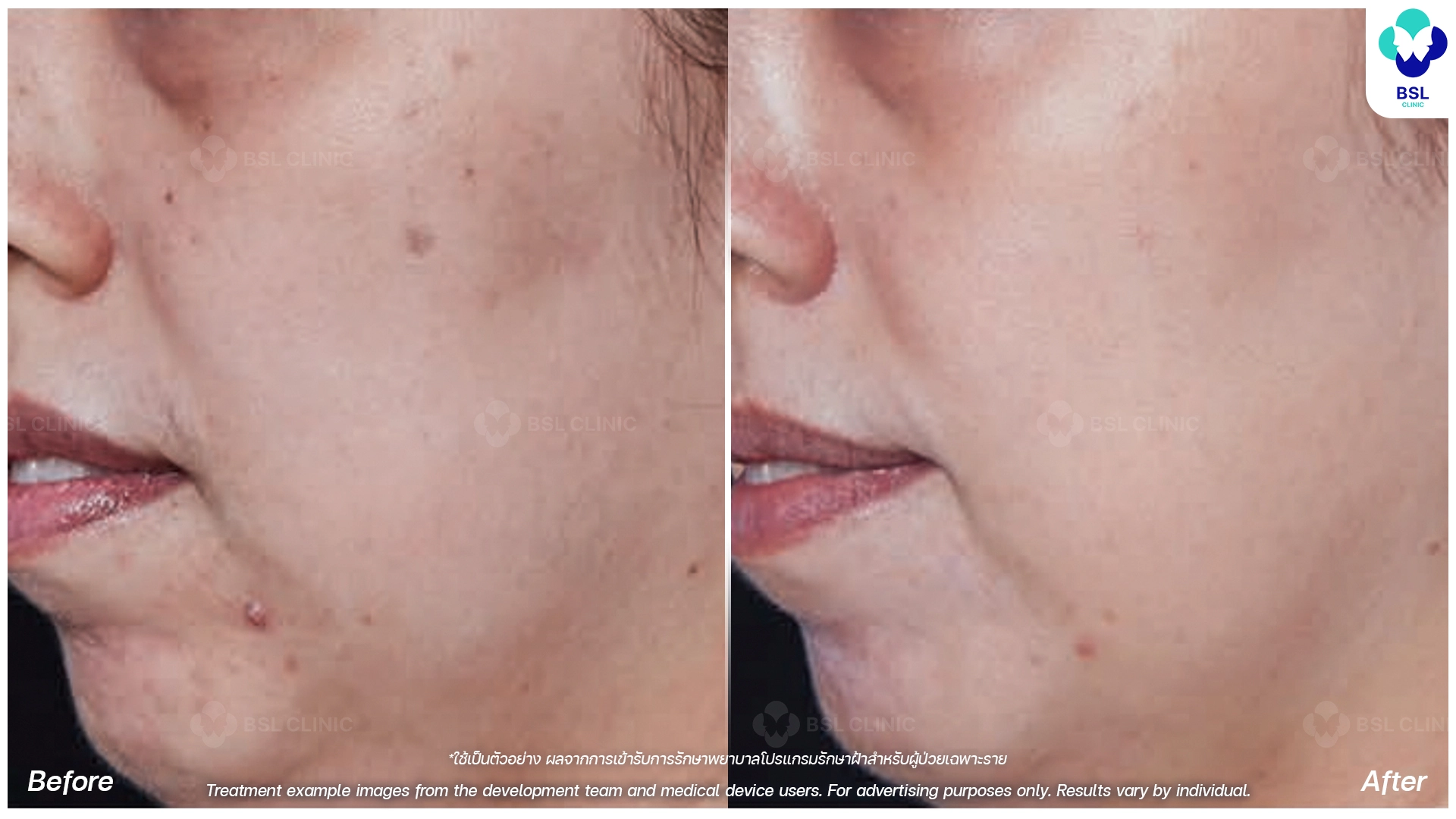 picoway laser before and after for pigmentation dark spots and uneven skin tone pico laser treatment bangkok thailand bsl clinic