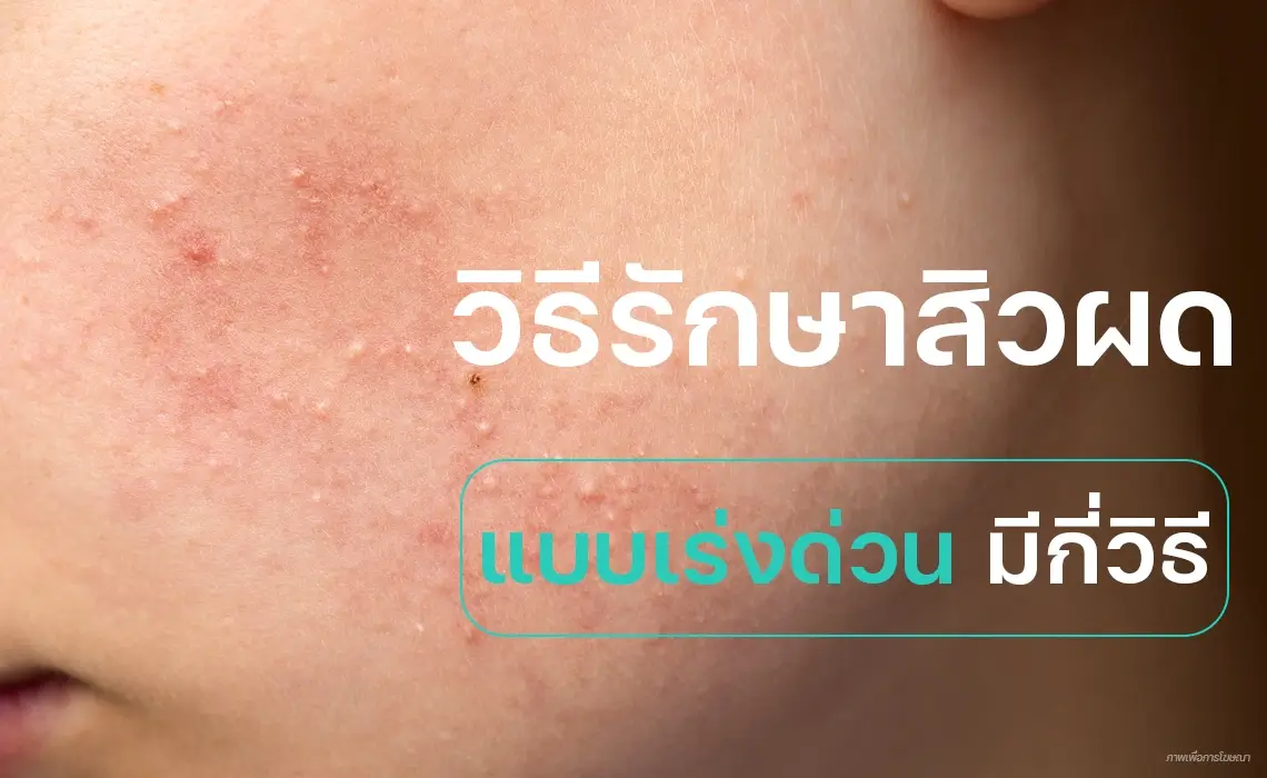 วิธีรักษาสิวผด แบบเร่งด่วน
