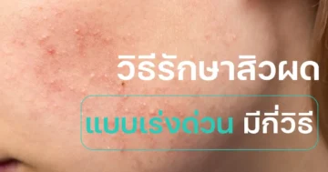 วิธีรักษาสิวผด แบบเร่งด่วน