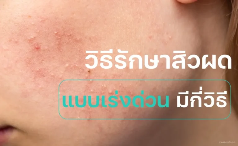 วิธีรักษาสิวผด แบบเร่งด่วน