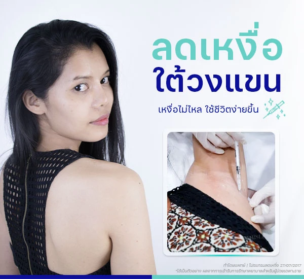 ลดเหงื่อใต้วงแขนที่ BSL Clinic เหงื่อไม่ไหล ใช้ชีวิตง่ายขึ้น