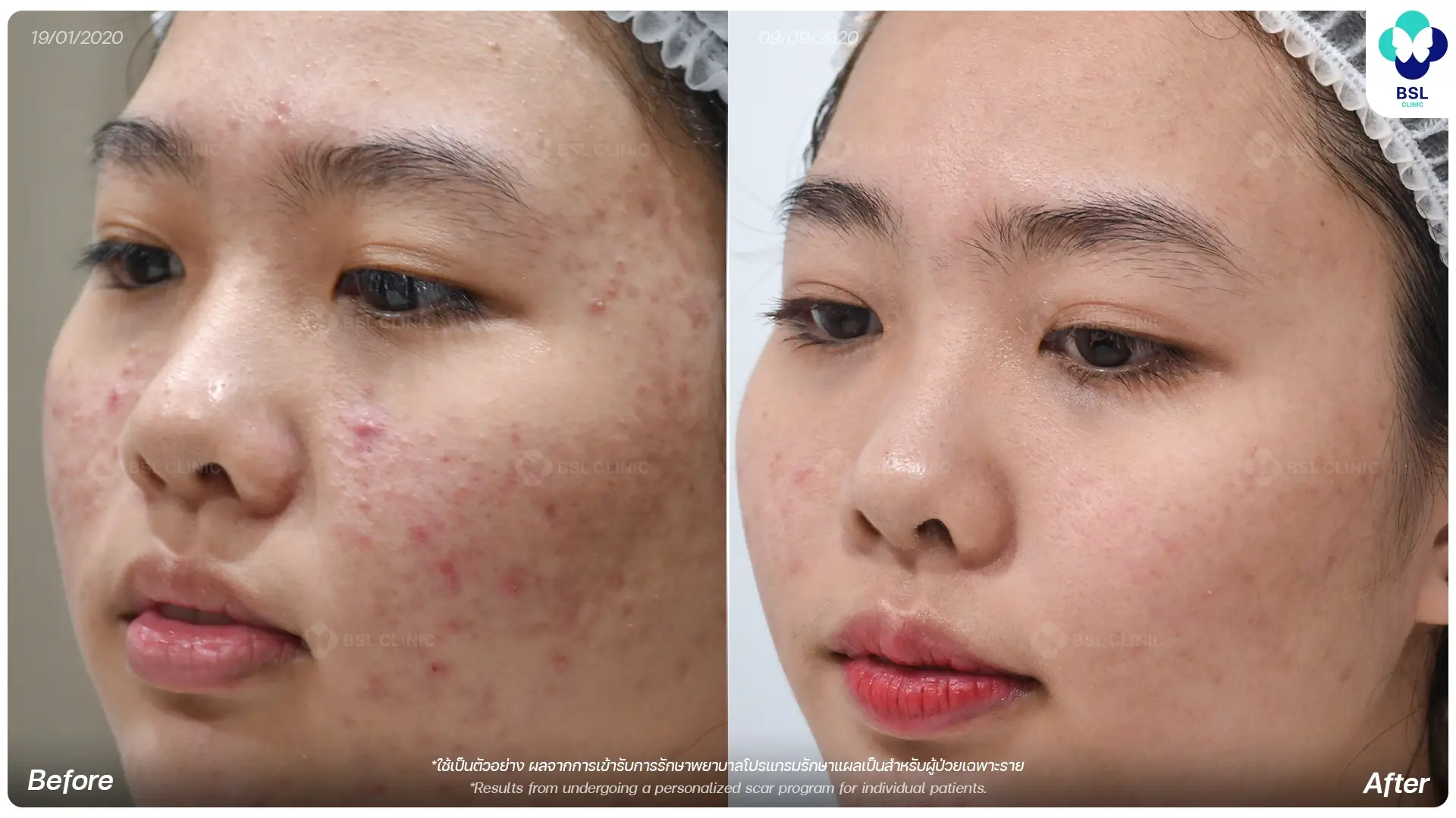 review 8 months acne treatment