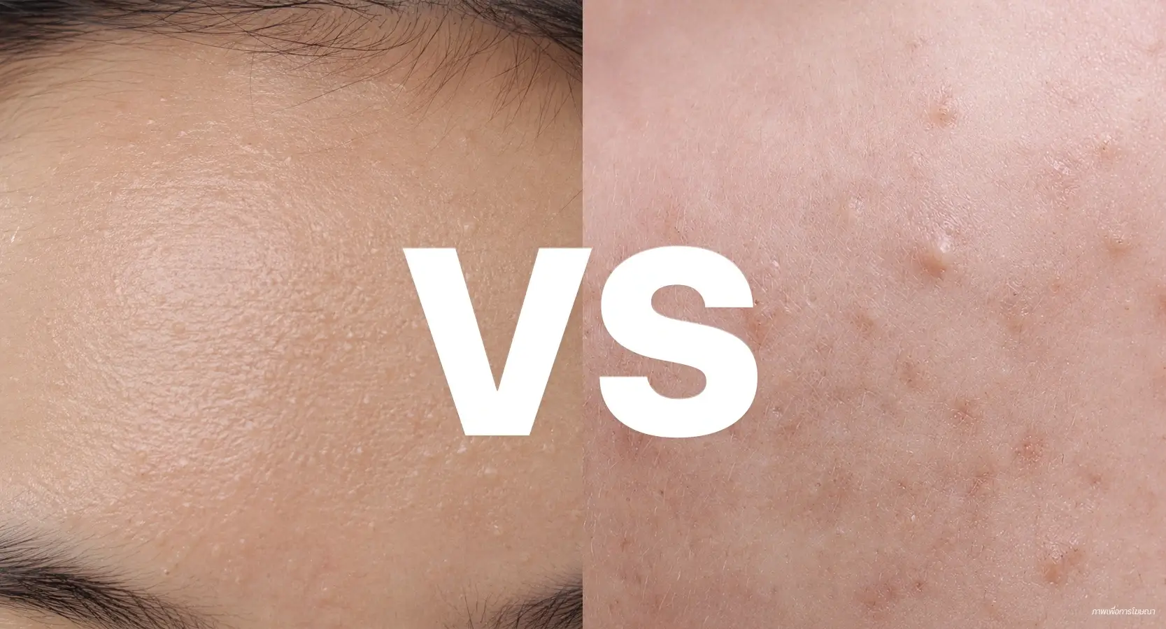 ความแตกต่างสิวผด VS สิวอุดตัน