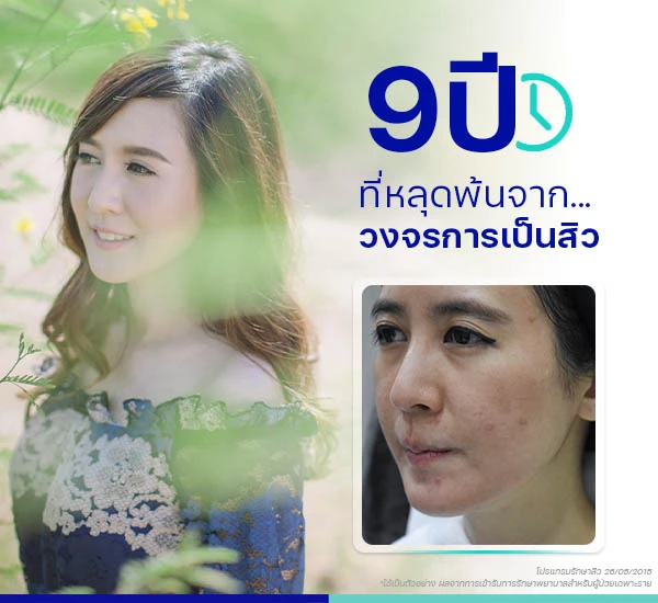 แชร์ประสบการณ์ รักษาสิว ทำให้หลุดพ้นจาก วัฏจักร วนเวียนการเป็นสิว คลินิกผิวหนัง รักษาสิว ฝ้า กระ แผลเป็น โดยแพทย์ | BSL Clinic