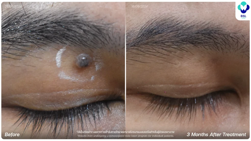 รักษา ไฝ-เลเซอร์ไฝใกล้ตา BSL Clinic คลินิกผิวหนัง รักษาสิว ฝ้า กระ แผลเป็น โดยแพทย์ | BSL Clinic