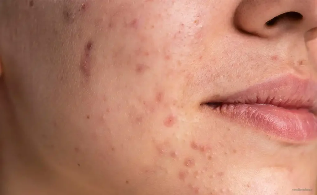 acne ปัญหาสิว