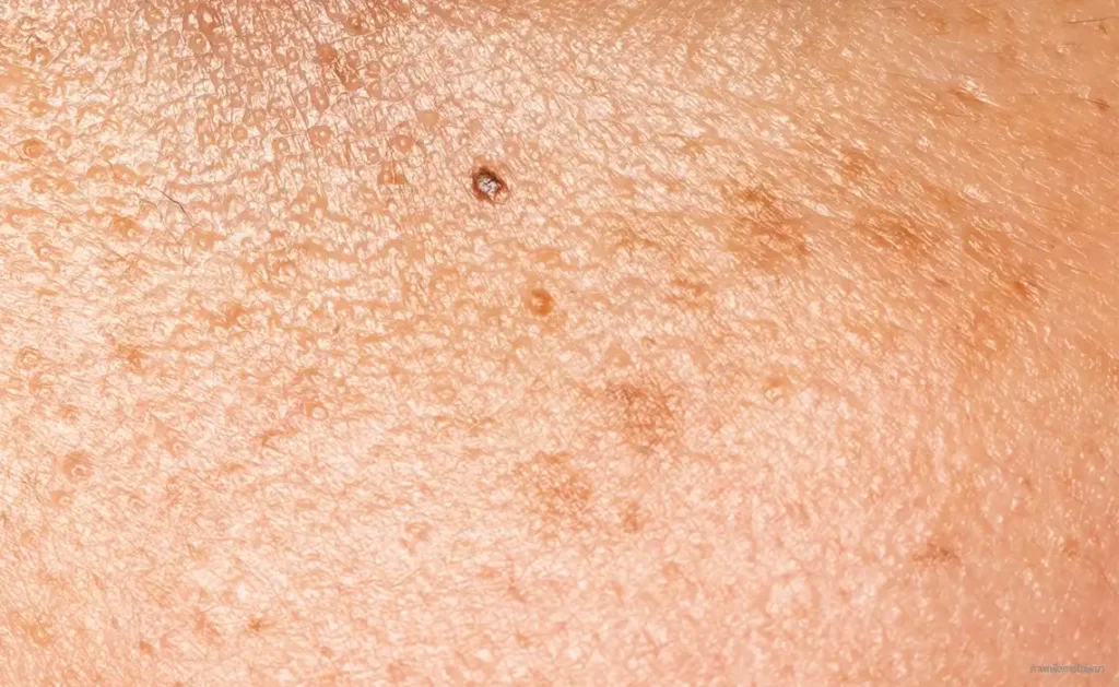 freckles กระ
