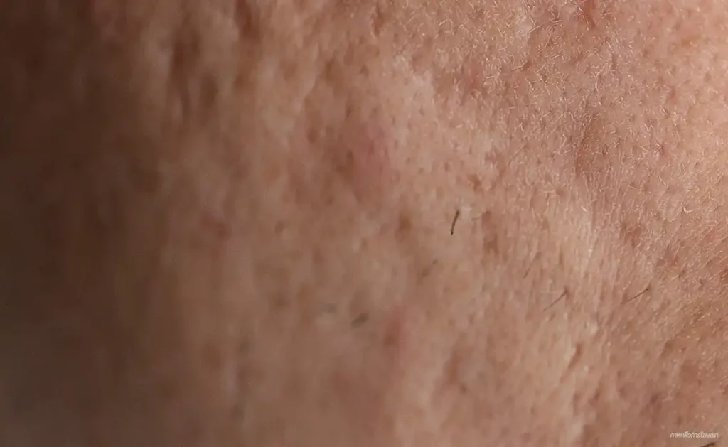 scars รอยแผลเป็น