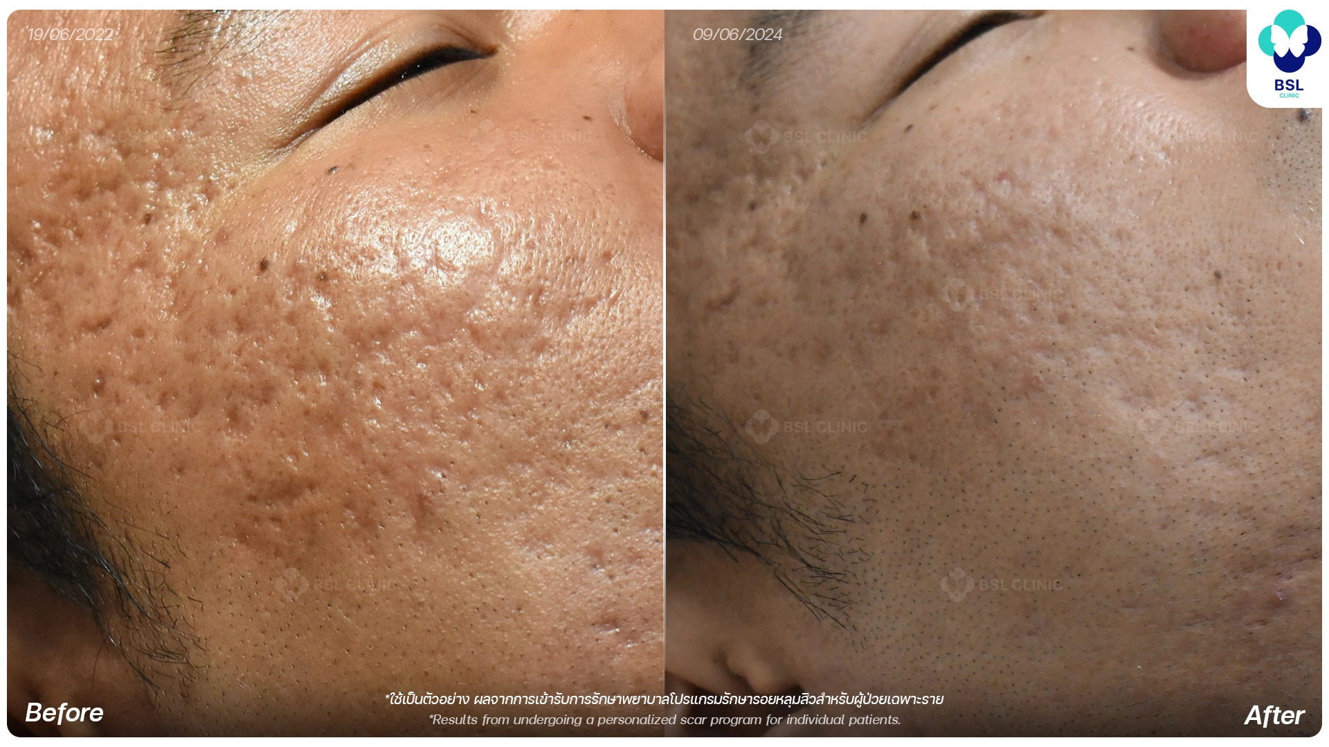 รีวิวรักษาหลุมสิว ก่อนและหลังการรักษาที่ BSL Clinic ช่วยให้หลุมสิวดูตื้นขึ้นและผิวเรียบเนียน โดยแพทย์ผู้เชี่ยวชาญ