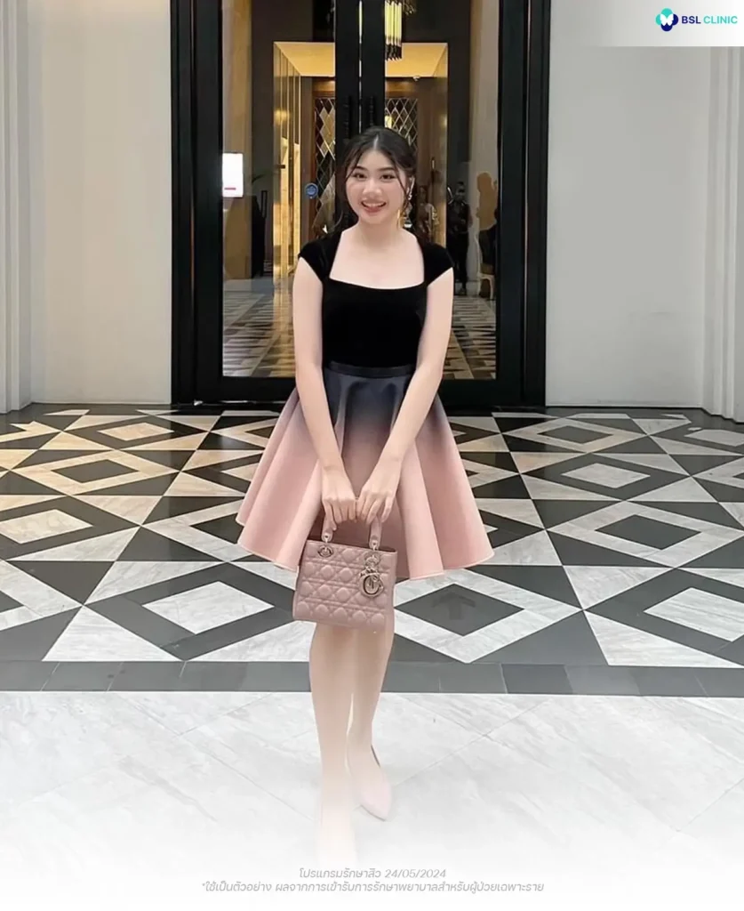 รีวิวรักษาสิว หลุมสิวจากผู้รับบริการจริง