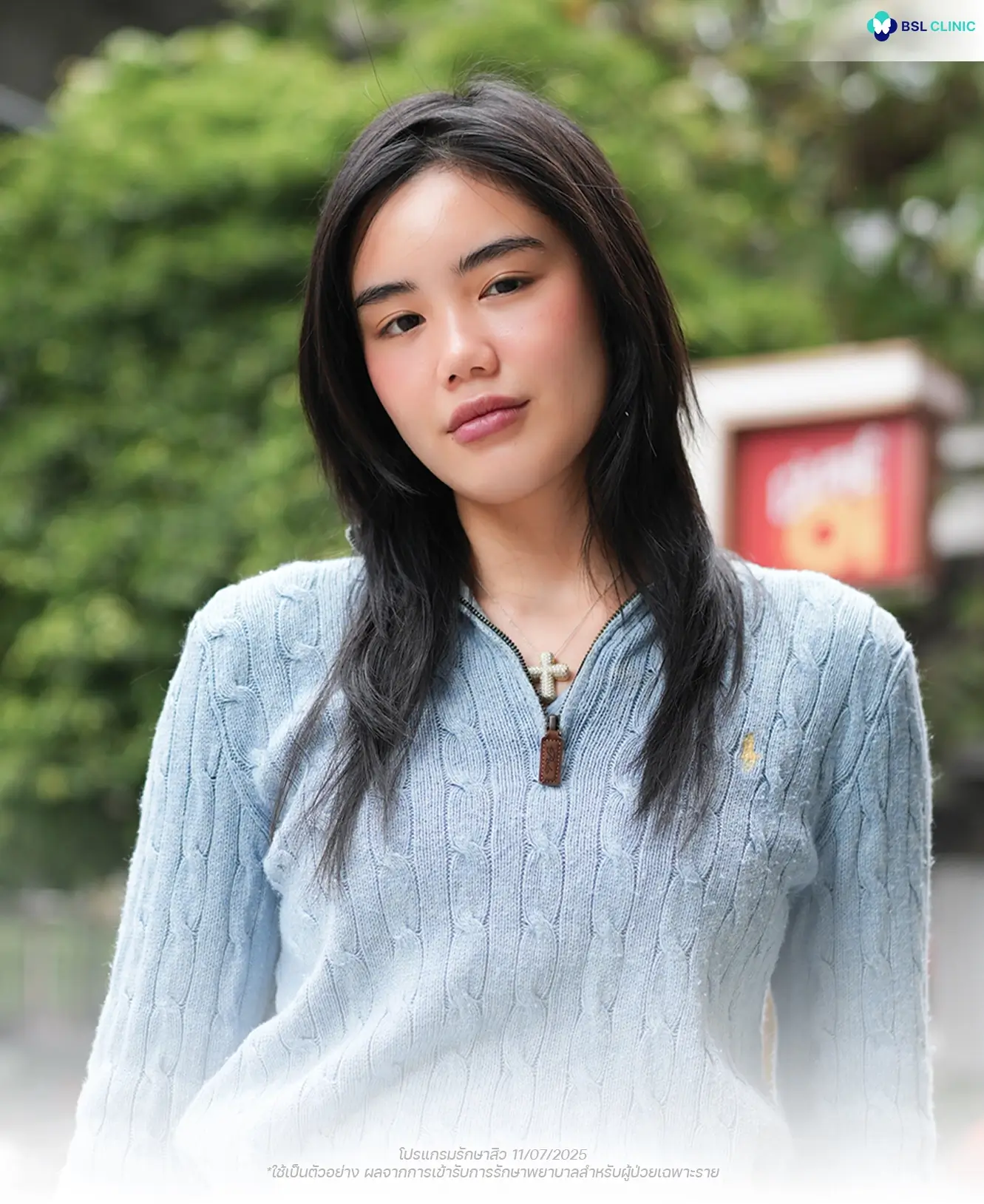 ผู้รับบริการจริงแบ่งปันประสบการณ์หลังรักษาสิวอุดตันและสิวอักเสบที่ BSL Clinic