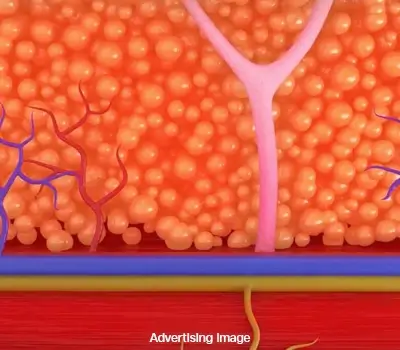 Illustration of EMsculpt Neo technology targeting fat tissue for non-invasive body sculpting