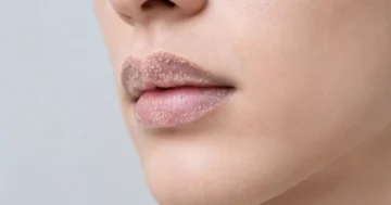 Fordyce spots on lips