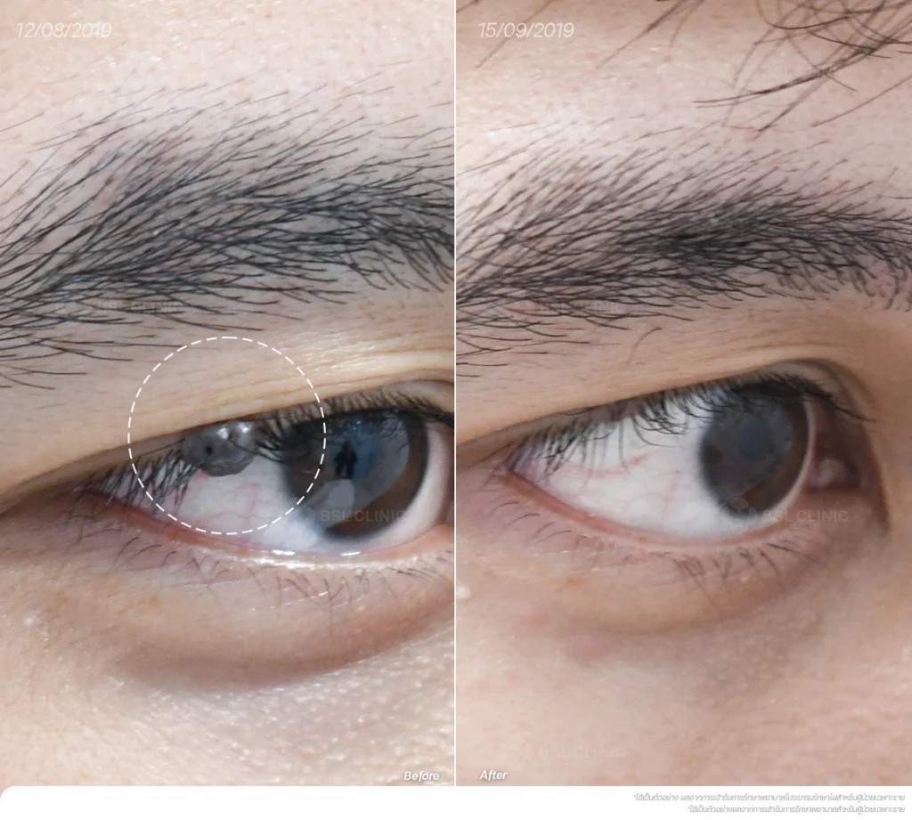 ภาพผลการเลเซอร์ไฝใต้ตา08