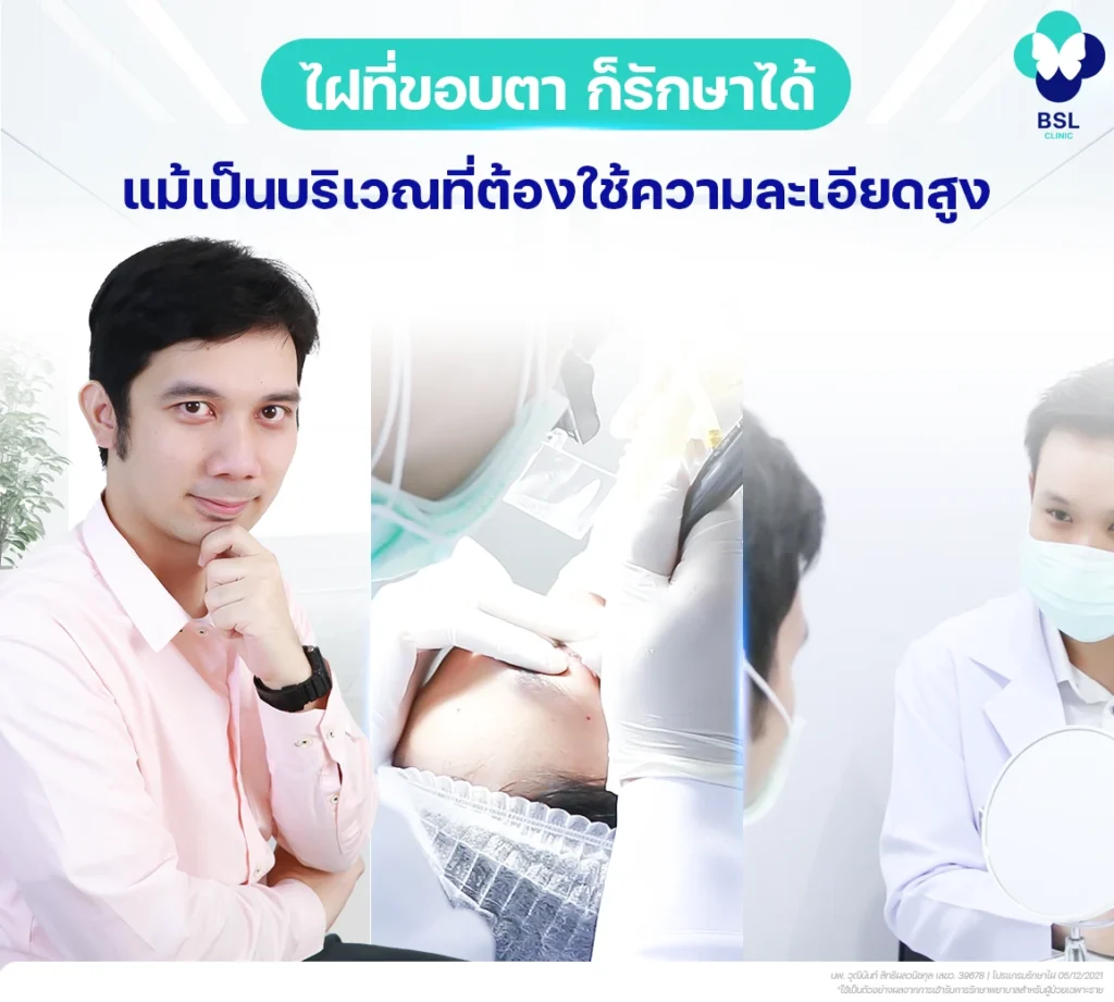 mole-under-eye-before-after-co2-laser-08-2