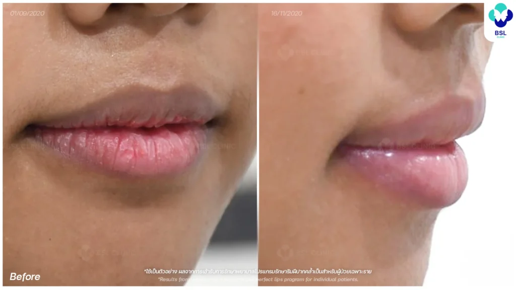 ริมฝีปากดำ