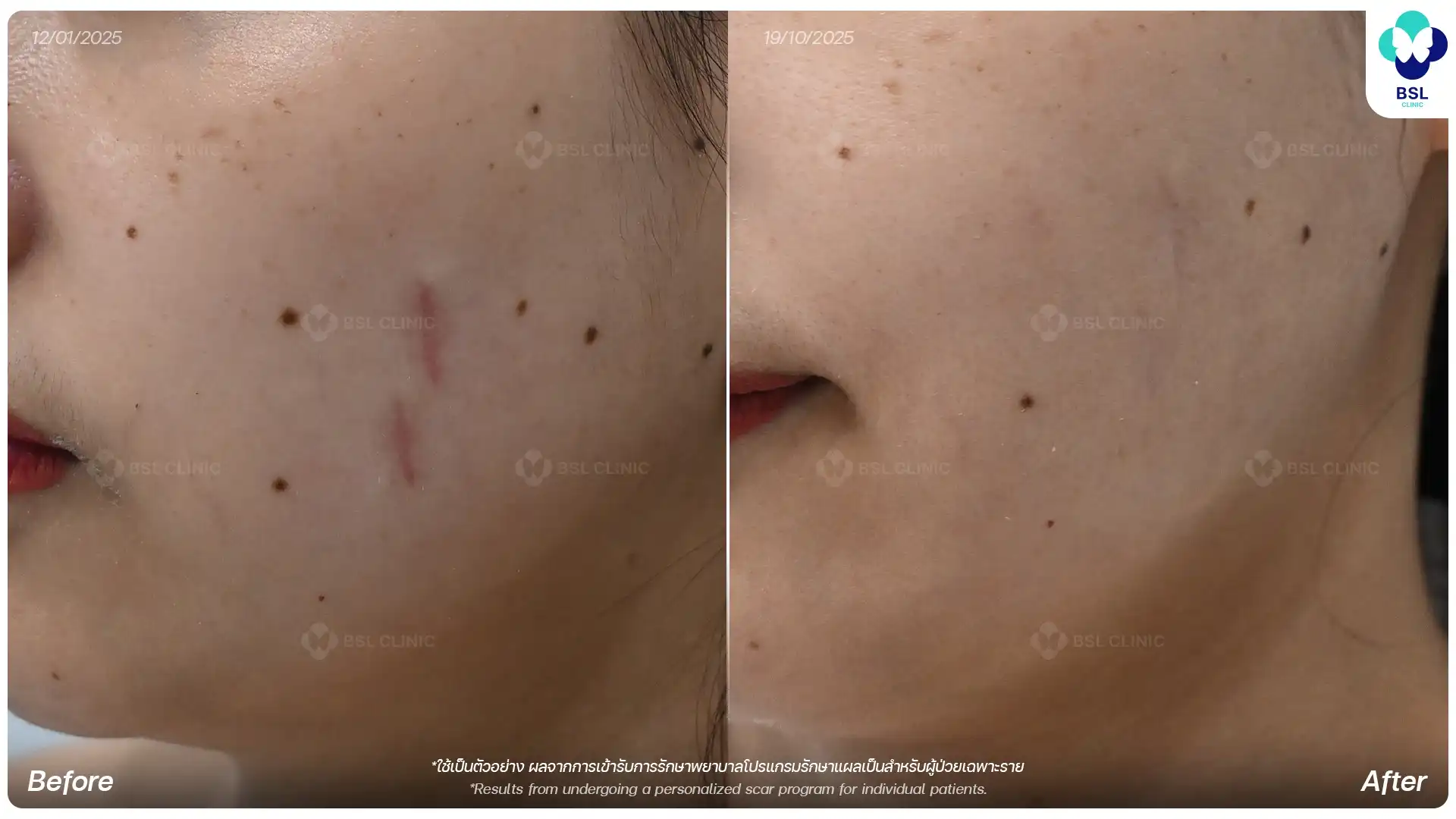 ผลก่อนและหลังการรักษารอยแผลเป็นผ่าตัดของคุณด้าย-นพิษฐา เกตุวิทยา ผู้รับบริการจริงที่ BSL Clinic