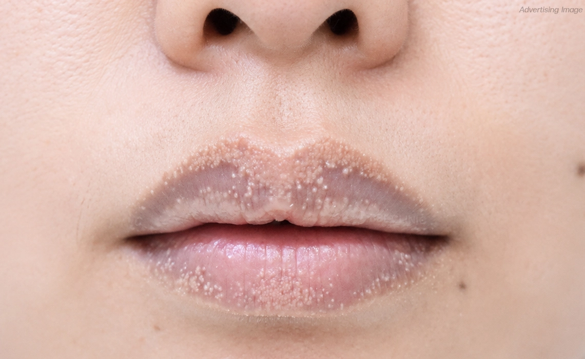 What Do Fordyce Spots on Lips Look Like