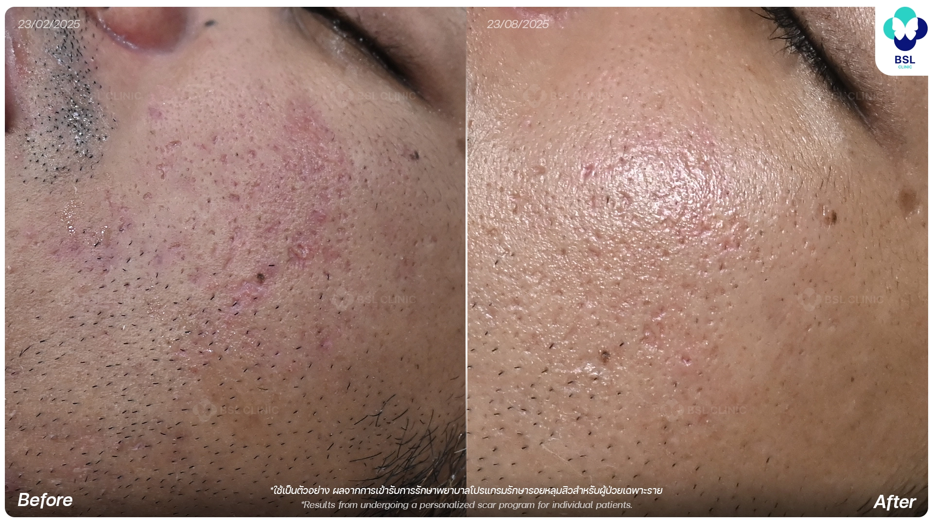 รีวิวรักษาหลุมสิว ก่อนและหลังการรักษาที่ BSL Clinic ช่วยให้หลุมสิวดูตื้นขึ้นและผิวเรียบเนียน โดยแพทย์ผู้เชี่ยวชาญ
