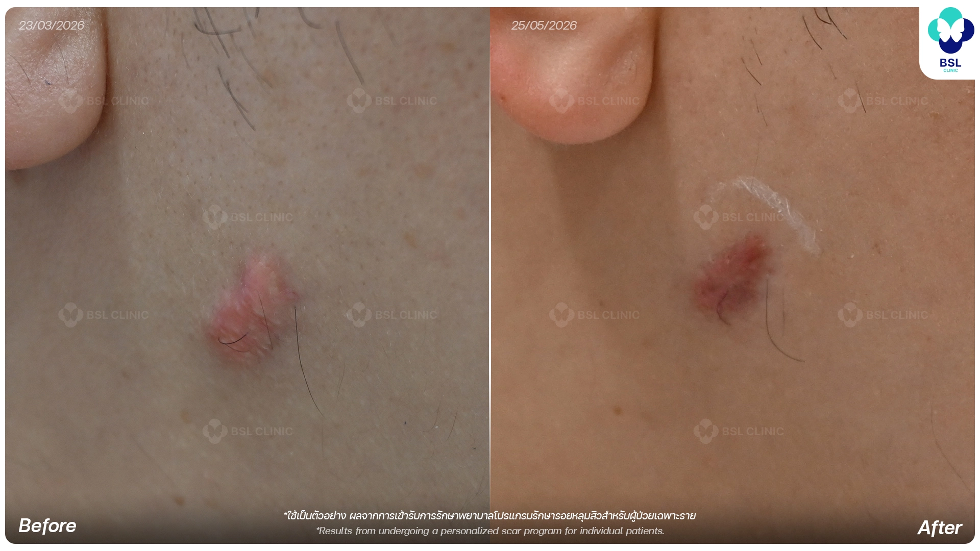 รีวิวรักษาหลุมสิวด้วยเลเซอร์หลุมสิว ก่อนและหลังการรักษา ช่วยให้ผิวดูเรียบเนียนขึ้นที่ BSL Clinic