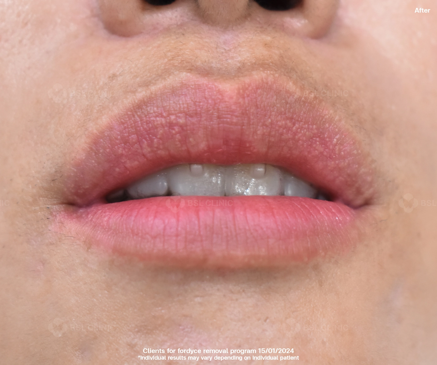 Fordyce Spot After CO2 Laser Lip Treatment Skin Tag Milia Syringoma Smooth Recovery BSL Clinic