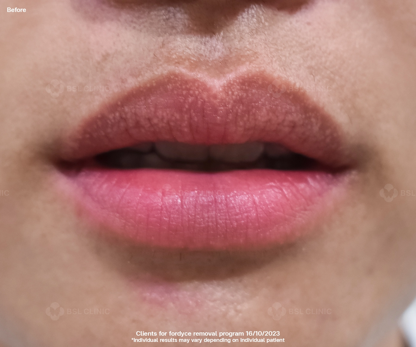 Fordyce Spot Before CO2 Laser Lip Treatment Skin Tag Milia Syringoma Smooth Recovery BSL Clinic