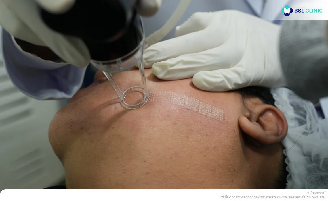 fractional-co2-laser-program