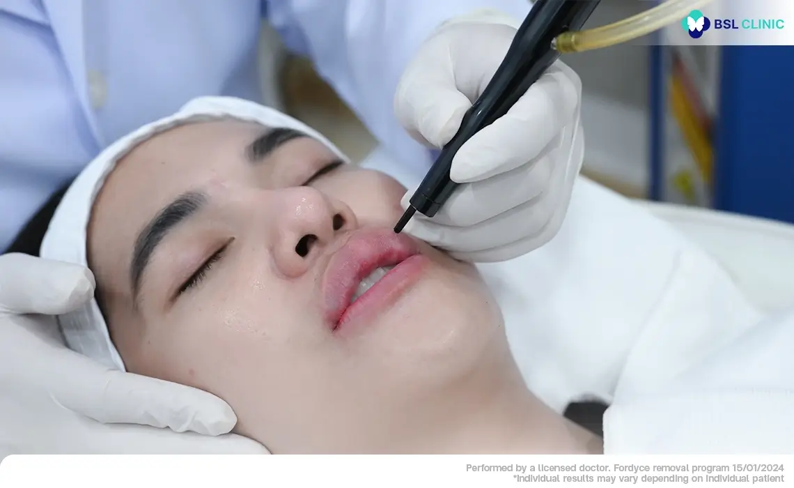 micro-pulse-co2-laser-treatment-upper-lip-fordyce-spot-removal-skin-tag-milia-smooth-healing-bsl-clinic