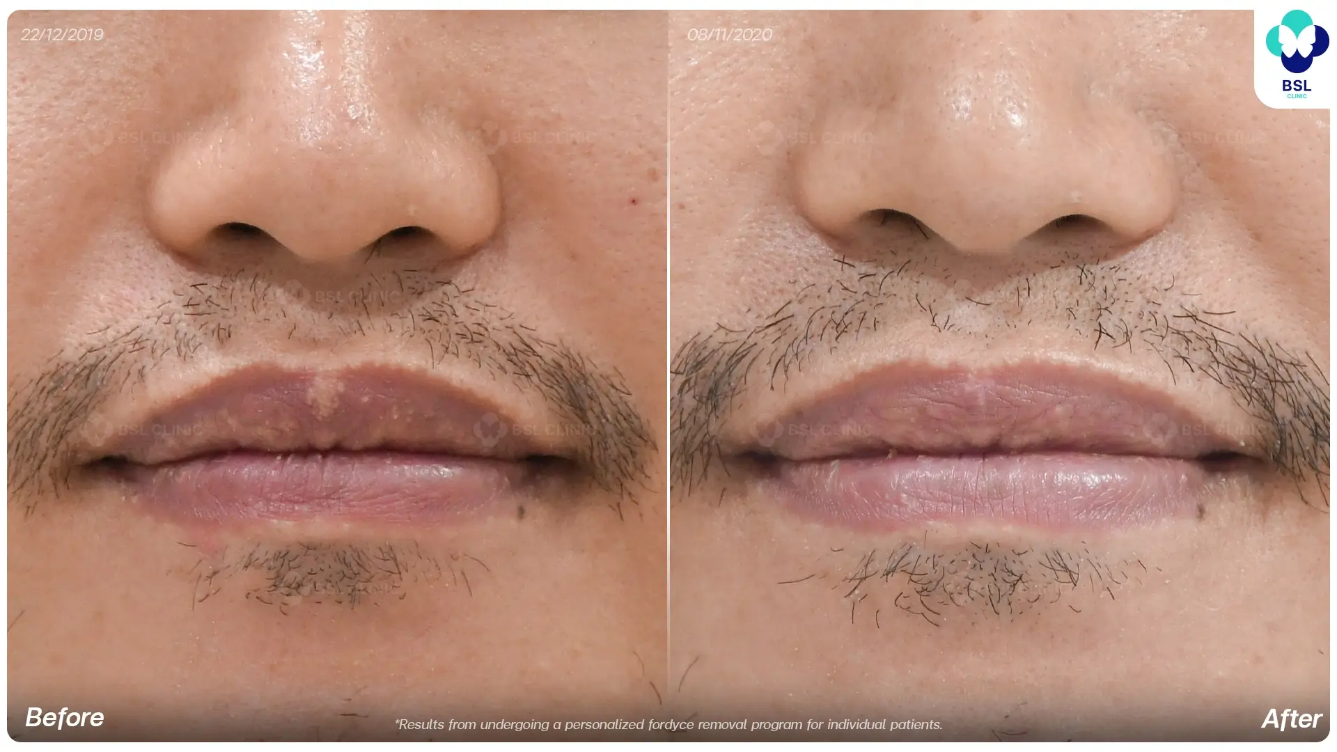 Before and after Fordyce spots treatment results at BSL Clinic
