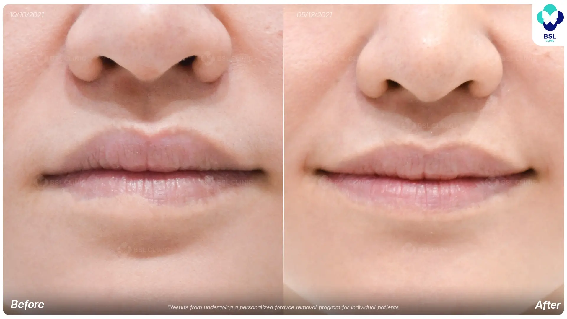 Before and after Fordyce spots treatment results at BSL Clinic