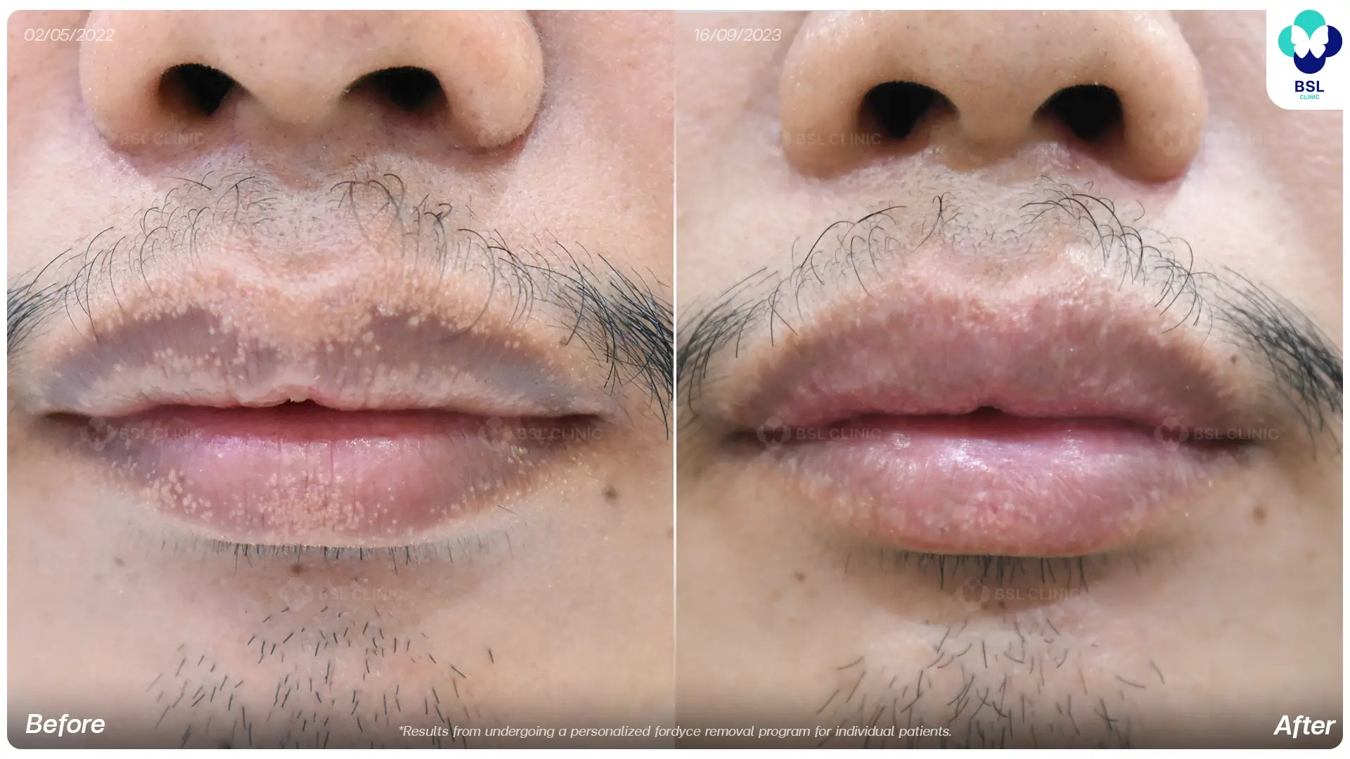 Before and after Fordyce spots treatment results at BSL Clinic
