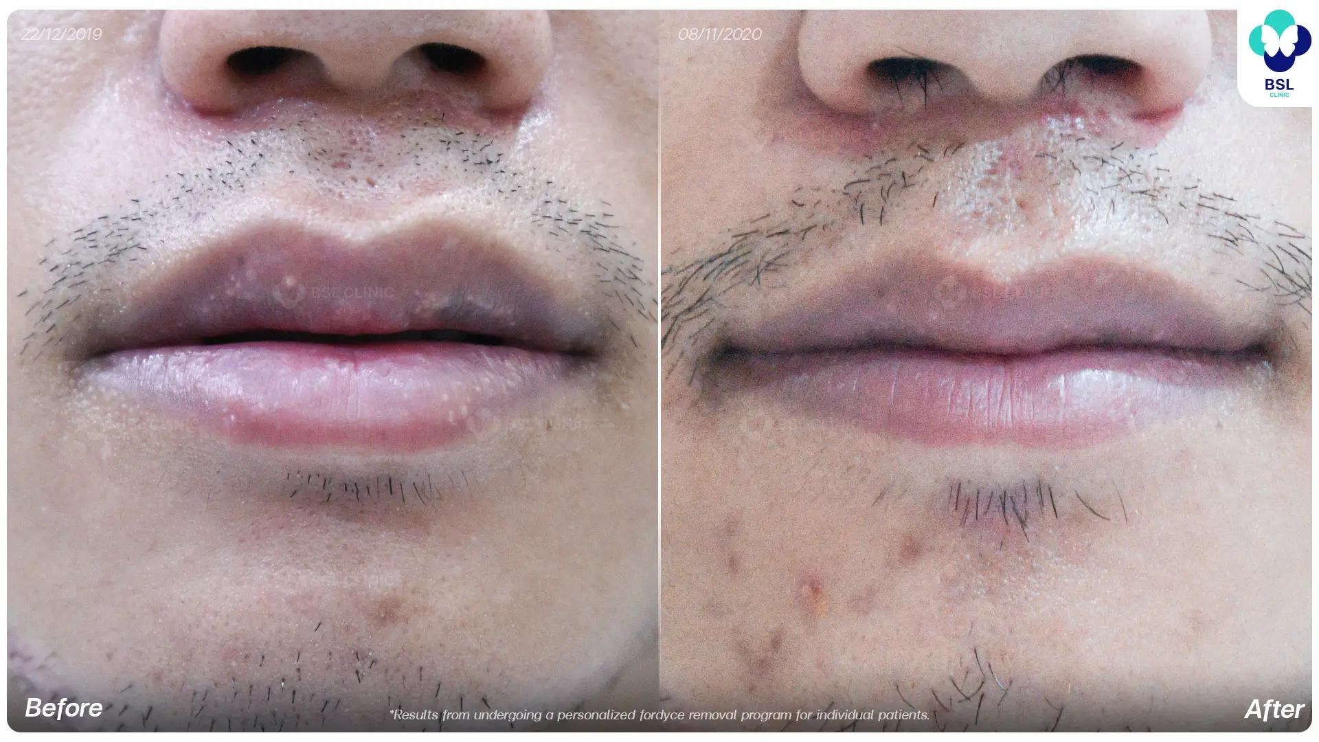 Before and after Fordyce spots treatment results at BSL Clinic
