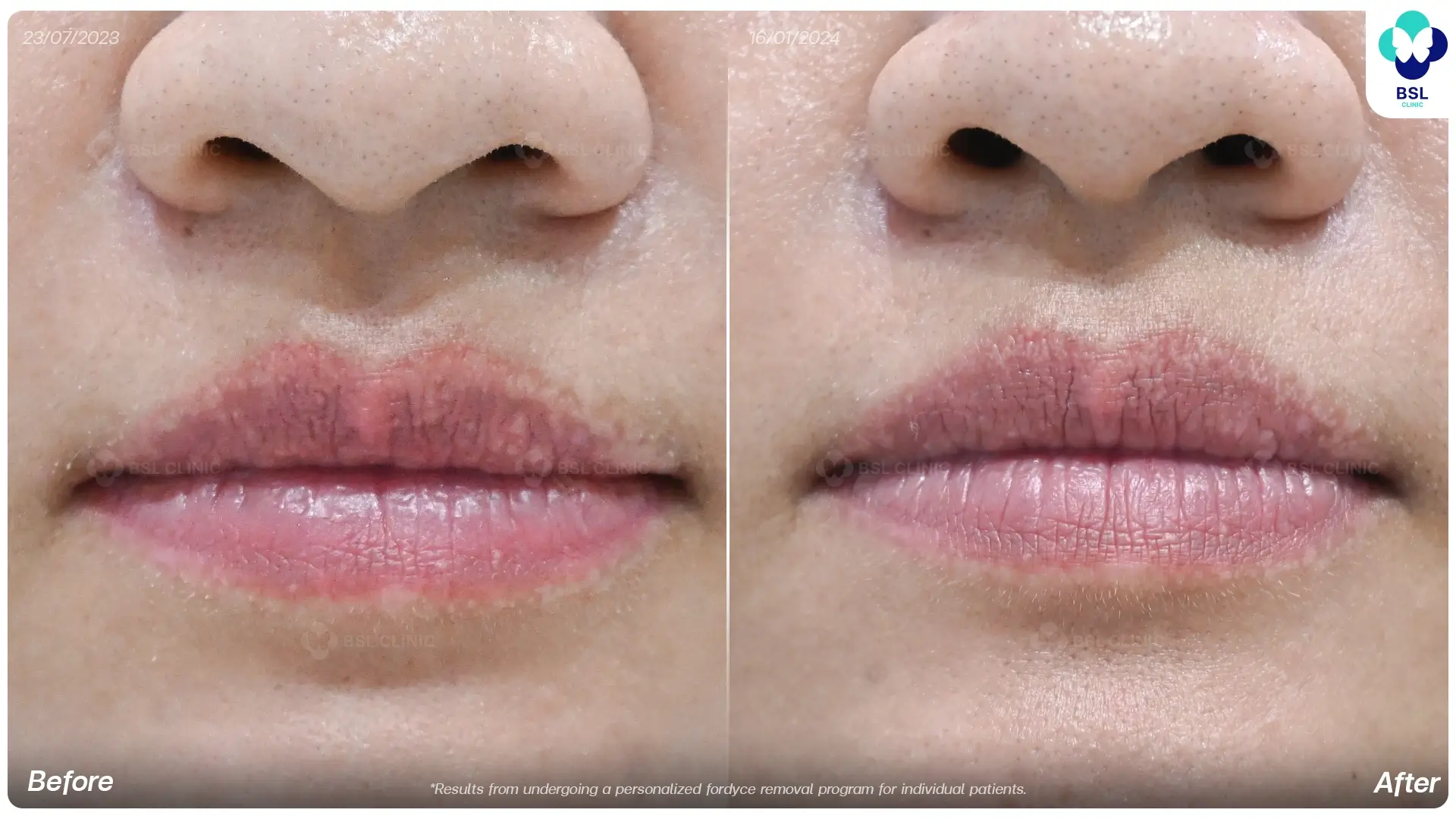 Before and after Fordyce spots treatment results at BSL Clinic