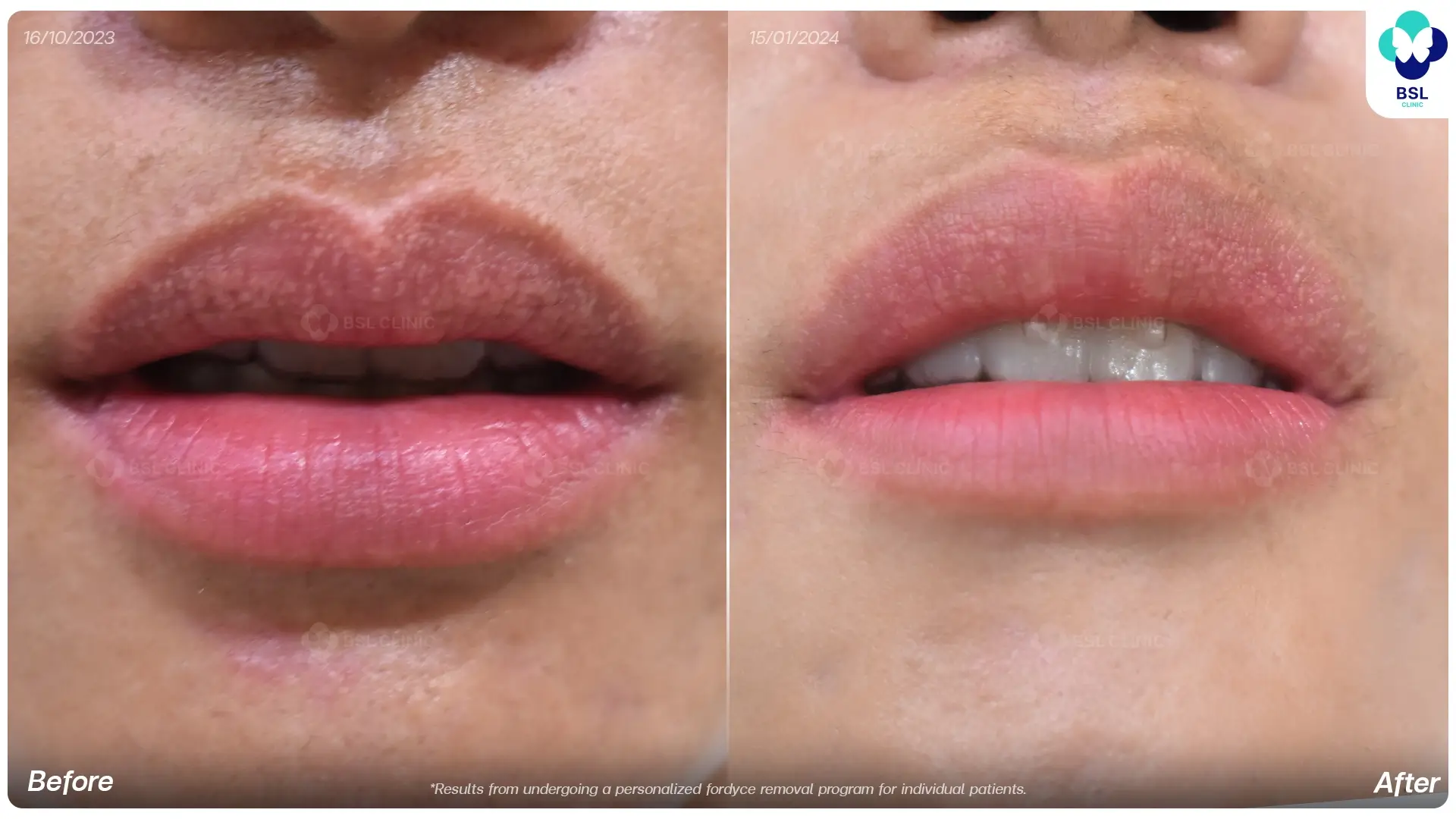 Before and after Fordyce spots treatment results at BSL Clinic