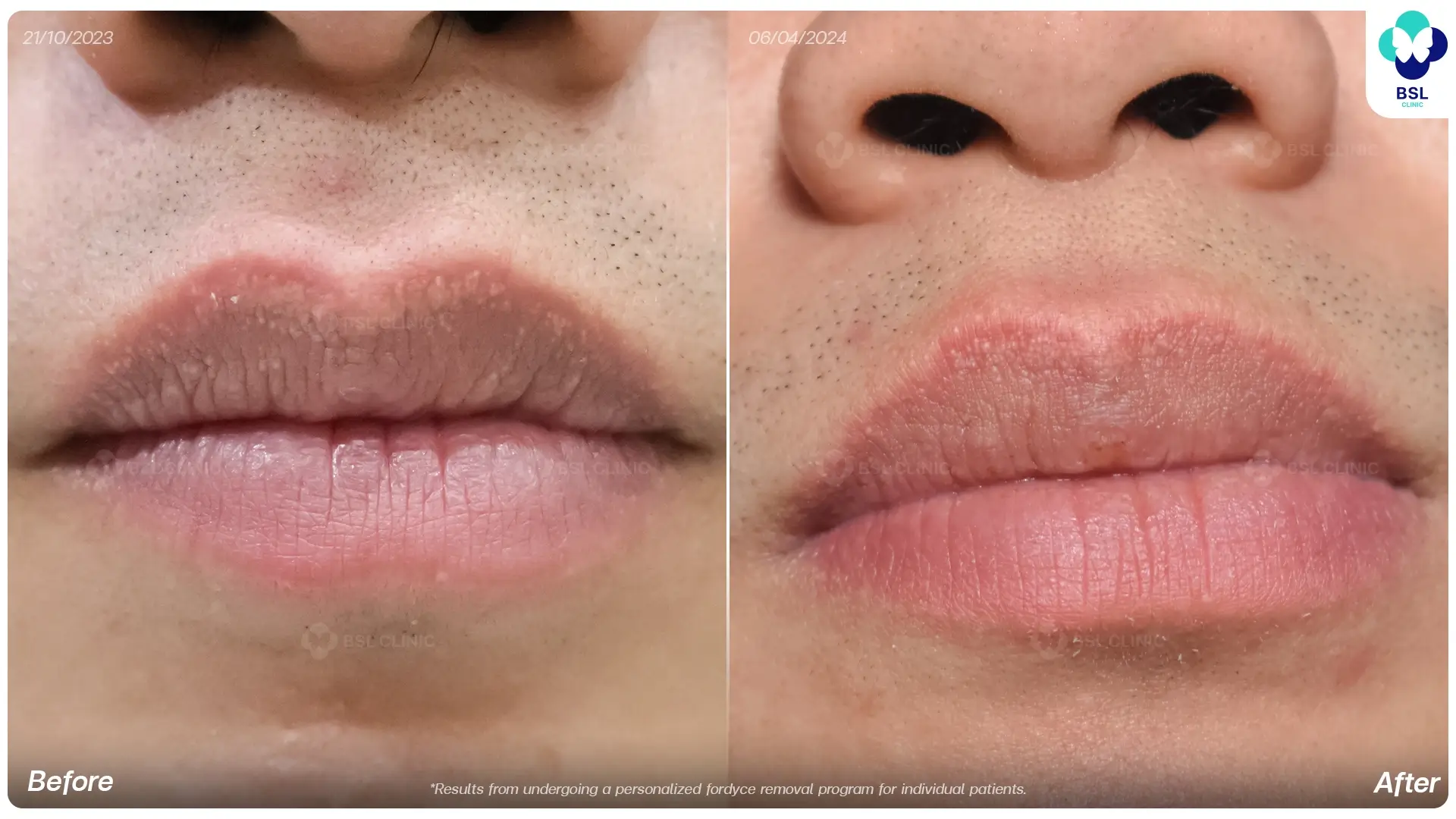 skin-tag-Fordyce-661053-L-อภิศักดิ์-ชินโคตร-BA-result