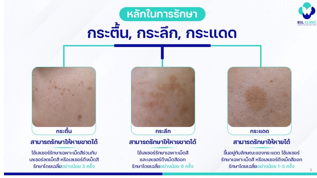 กระแต่ละประเภท