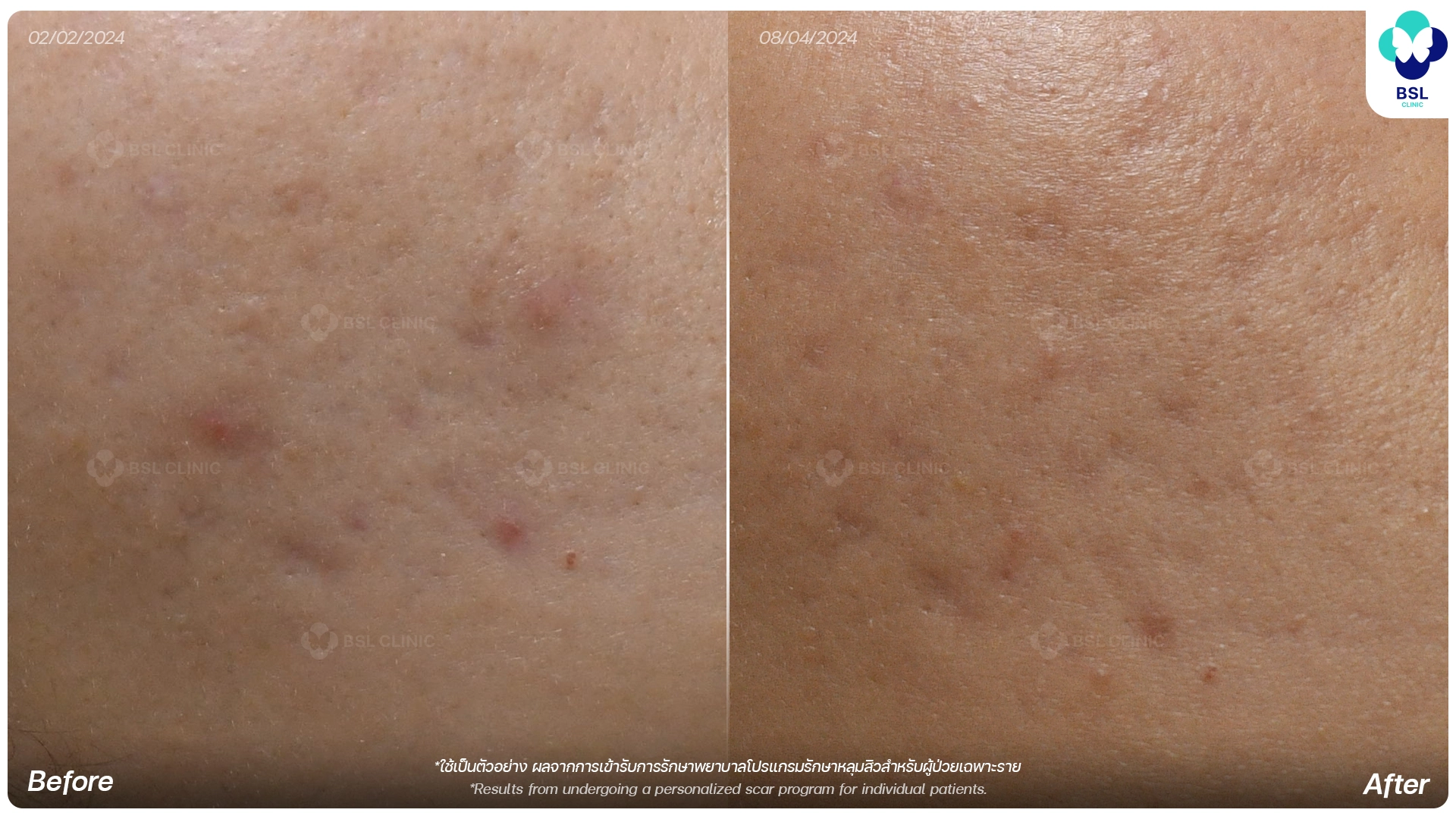 รีวิวรักษาหลุมสิวแบบแอ่งกระทะ ก่อนและหลังการรักษา ช่วยให้หลุมสิวดูตื้นขึ้นและผิวเรียบเนียน โดยแพทย์ผู้เชี่ยวชาญที่ BSL Clinic