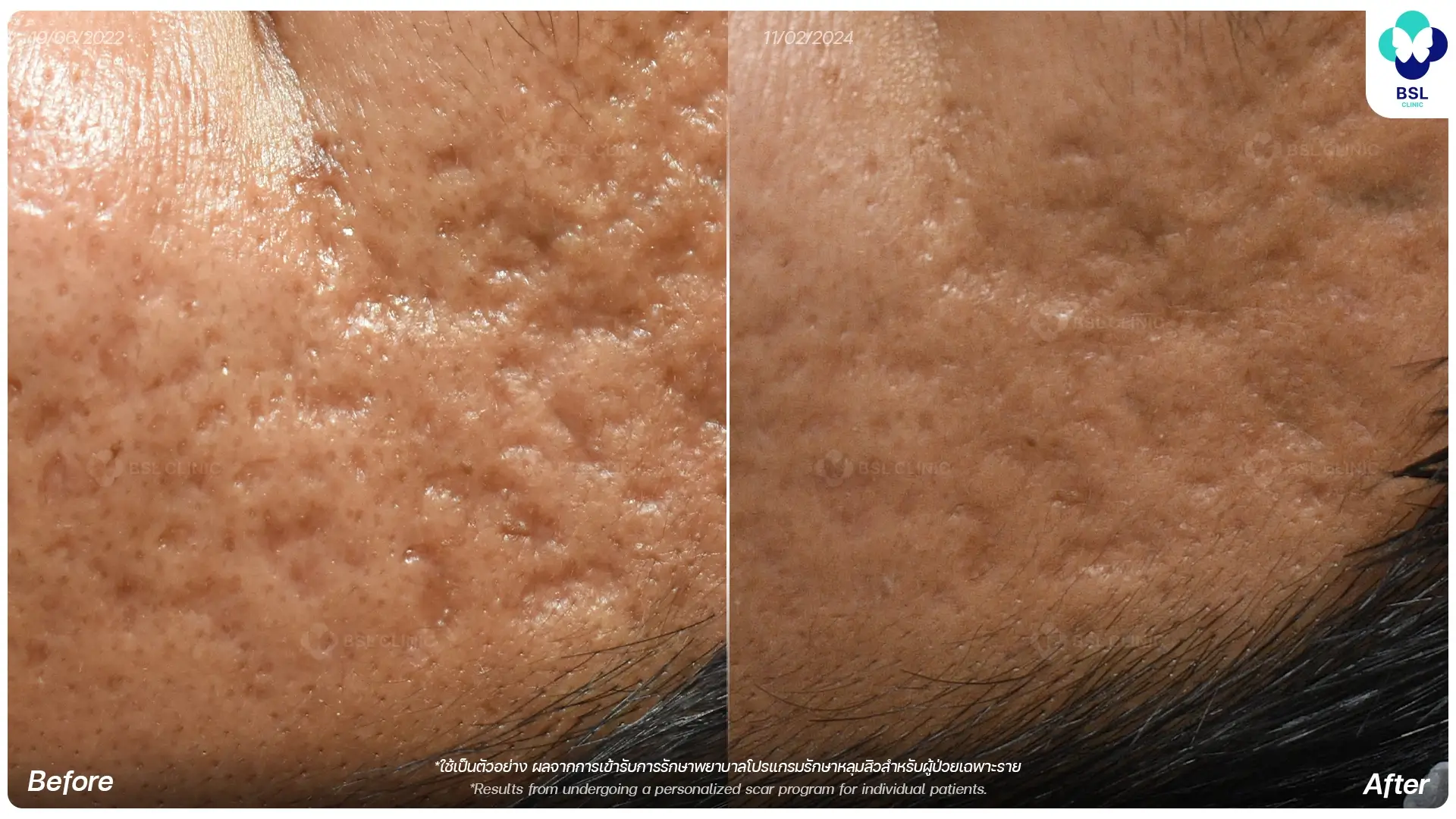 รีวิวรักษาหลุมสิวแบบแอ่งกระทะ Before After ที่ BSL Clinic