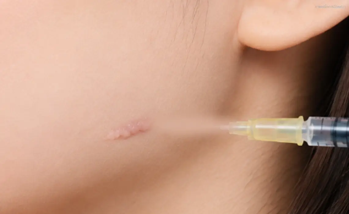 ฉีดคีลอยด์ keloid-injection