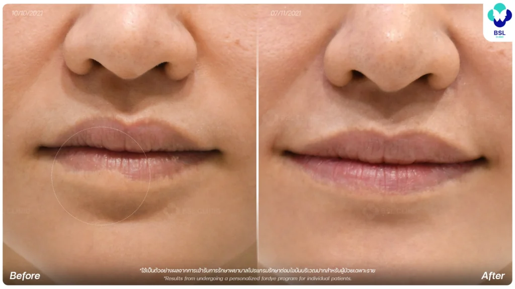 รีวิวริมฝีปากมีจุดขาว ๆ BSL Clinic