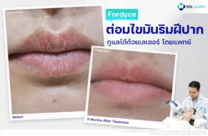 ริมฝีปากมีจุดขาวๆ