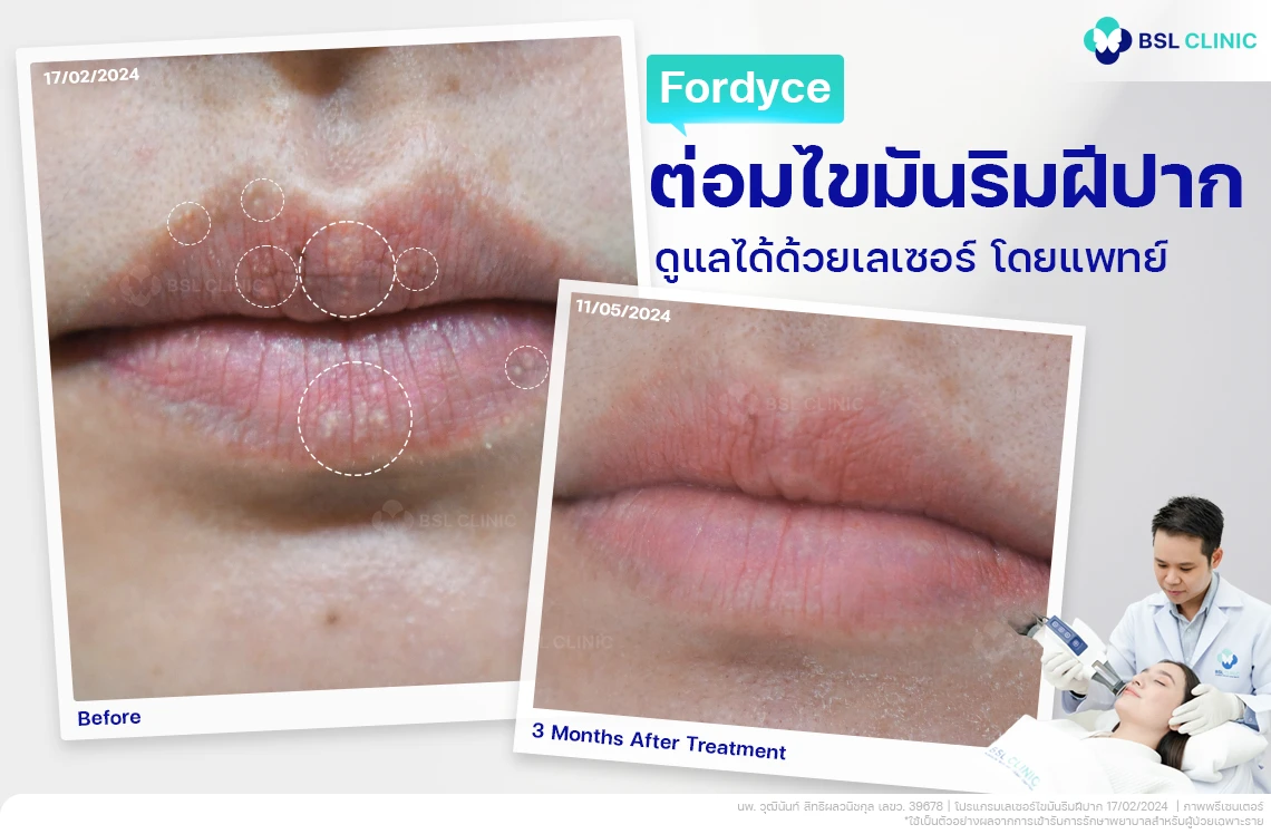 ริมฝีปากมีจุดขาวๆ