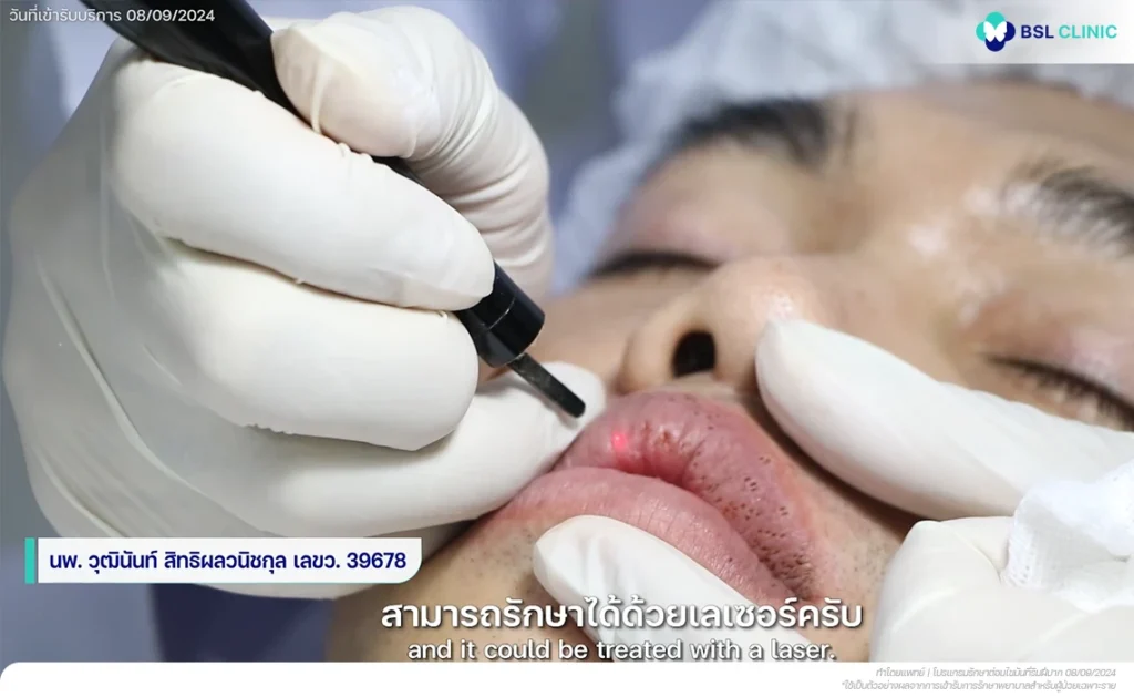 รีวิวริมฝีปากมีจุดขาว ๆ BSL Clinic