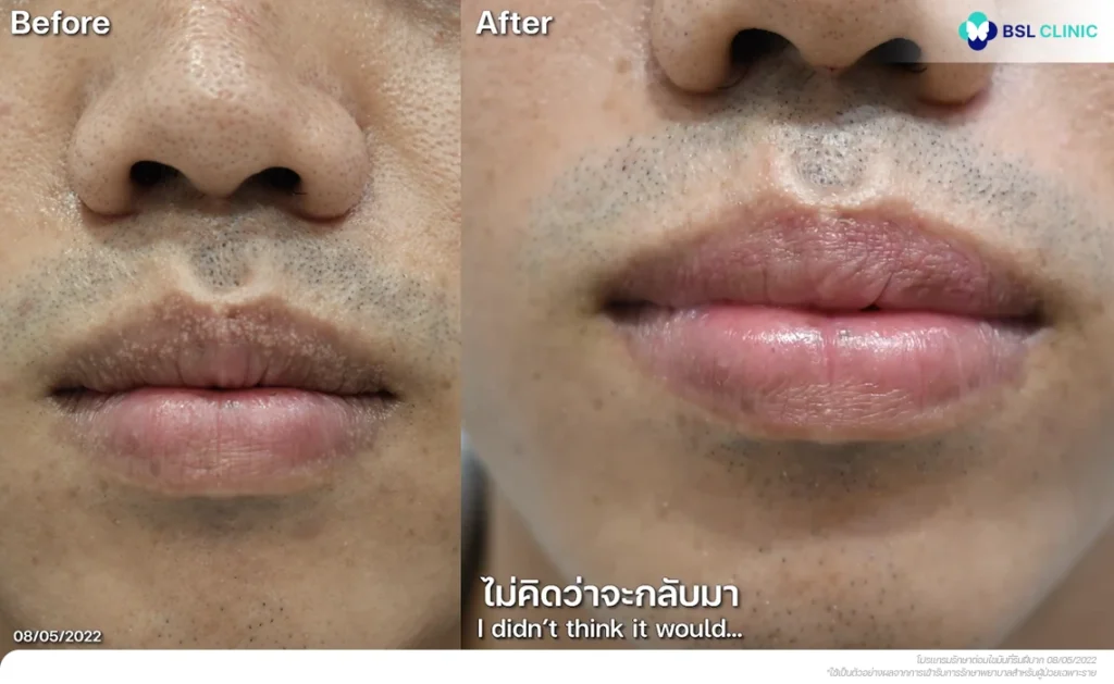 รีวิวริมฝีปากมีจุดขาว ๆ BSL Clinic