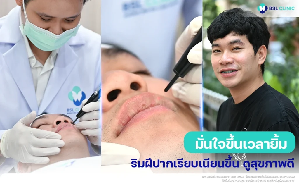 ริมฝีปากเรียบเนียนขึ้นหลังรักษาต่อมไขมันที่ปากด้วยเลเซอร์ BSL