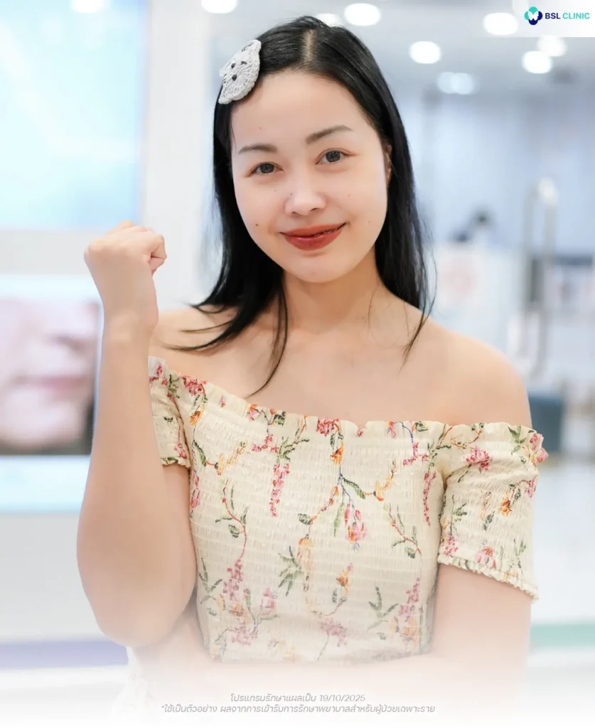 รีวิวจากผู้รับบริการจริงหลังรักษารอยแผลเป็นผ่าตัดด้วยเลเซอร์ที่ BSL Clinic