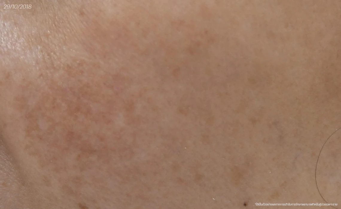 ฝ้า กระ-ฝ้า-Melasma