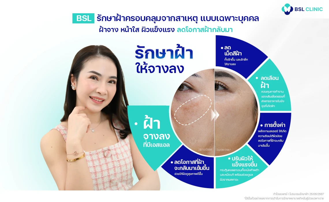 เลเซอร์รักษาฝ้ากระ ที่ BSL Clinic เลือกใช้