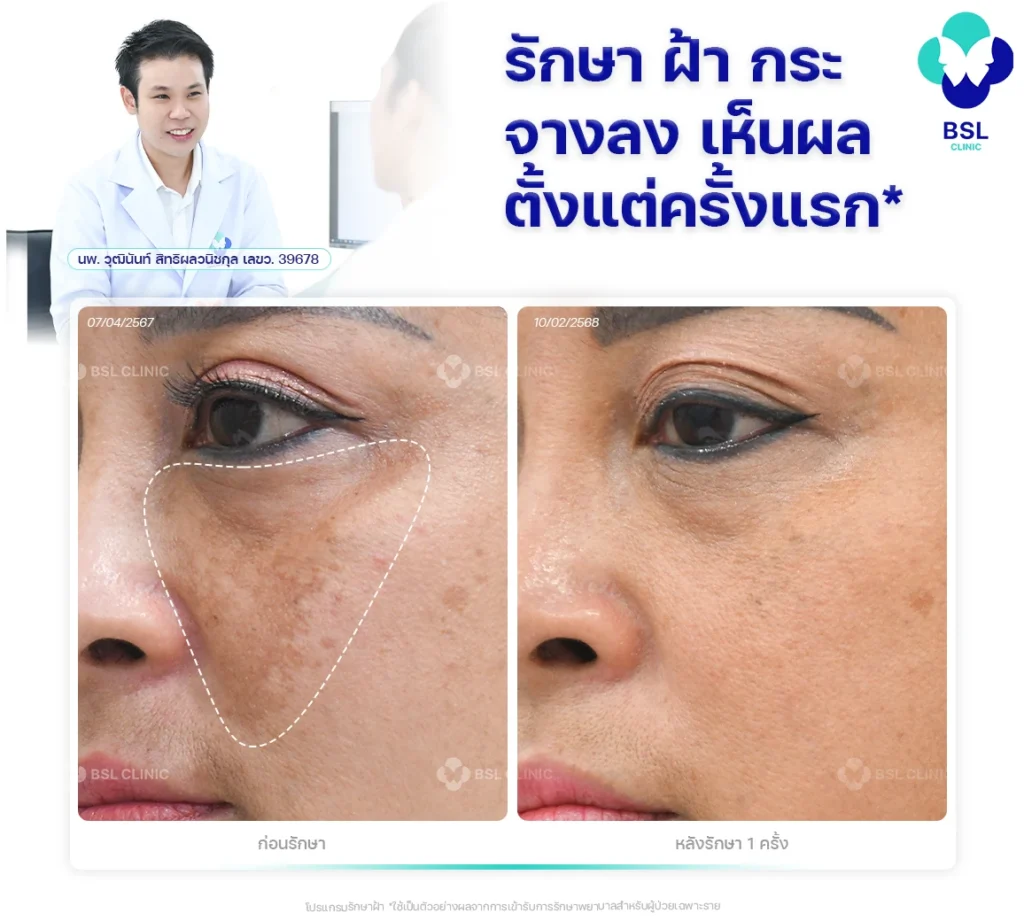 รักษาฝ้ากระจางลงเห็นผลตั้งแต่ครั้งแรก