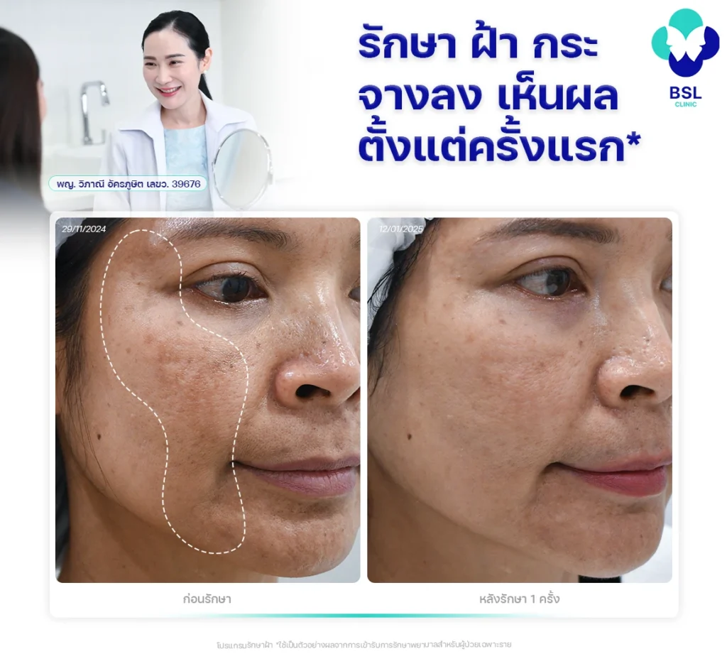 รักษาฝ้ากระจางลงเห็นผลตั้งแต่ครั้งแรก